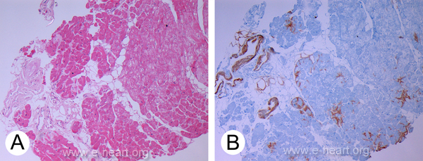 EMB & Amyloid